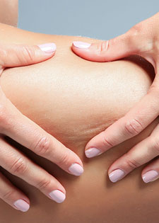 Les meilleures techniques pour lutter contre la cellulite